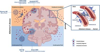 Integration of amyloid-β oligomerization tendency as a plasma biomarker in Alzheimer's disease diagnosis